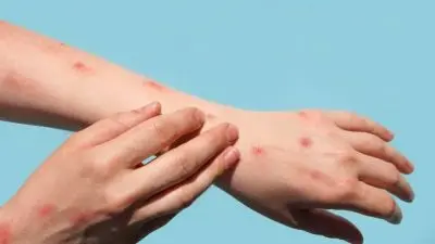 Maymun Çiçeği Virüsü Hakkında Son Gelişmeler: